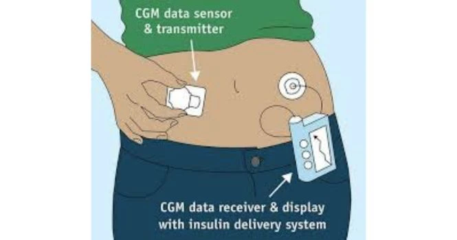cgm sensor
