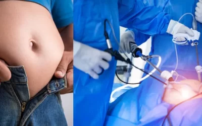 Weight Loss Surgery in India: An Overview
