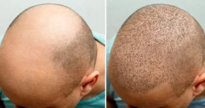 Hair Transplant in india