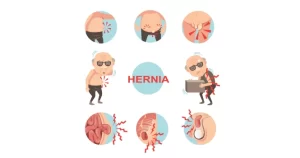 Hernia Surgery