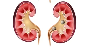 kidney stones