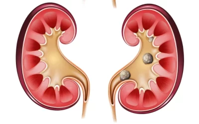 Kidney Stones: A Comprehensive Guide