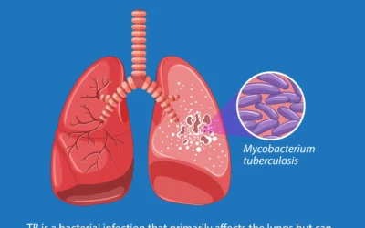 Tuberculosis Outbreak 2025: Latest Updates, Trends, and What You Need to Know