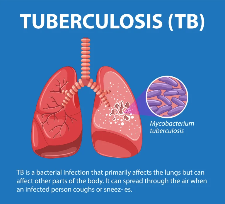 tuberculosis outbreak