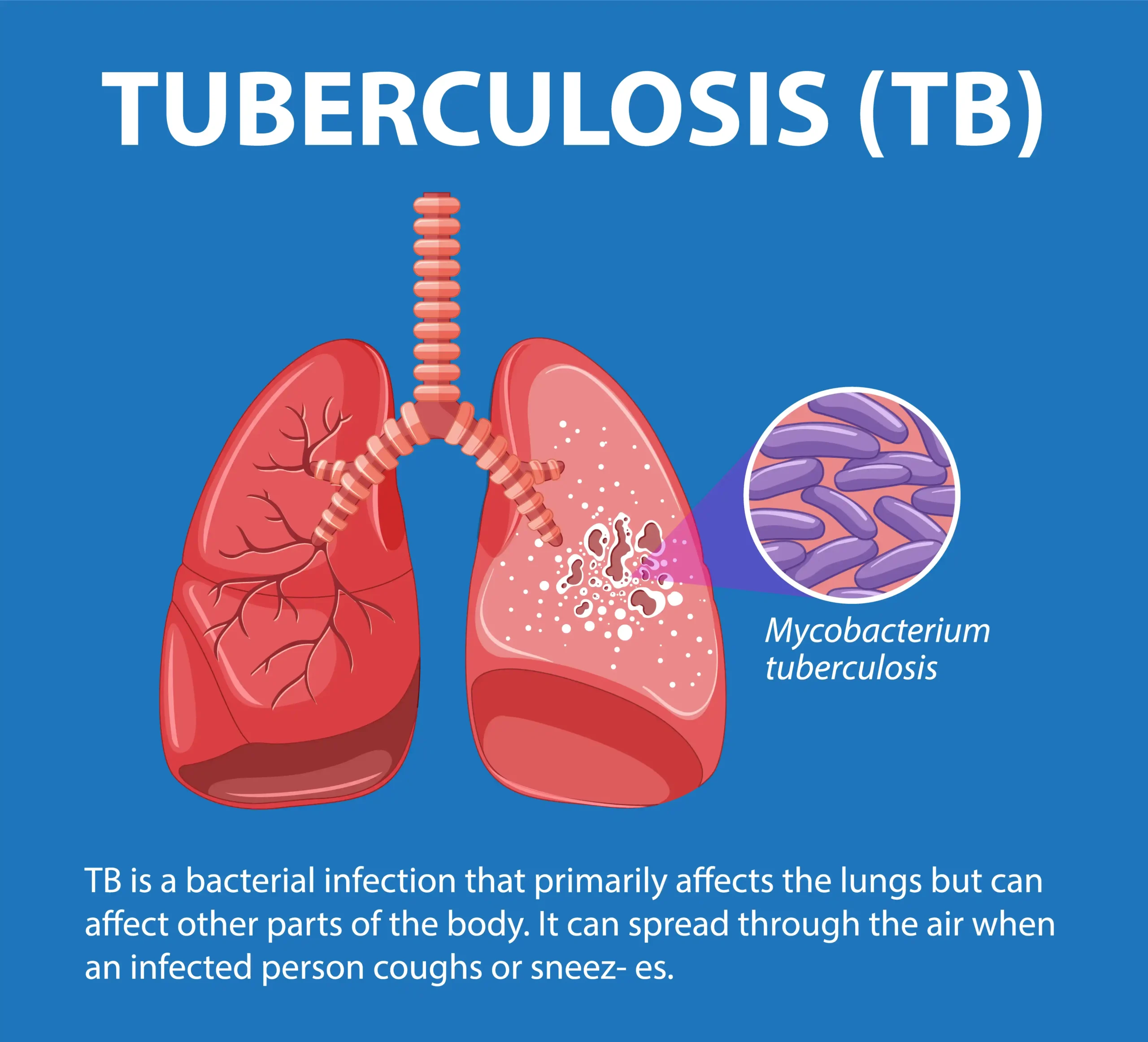 tuberculosis outbreak