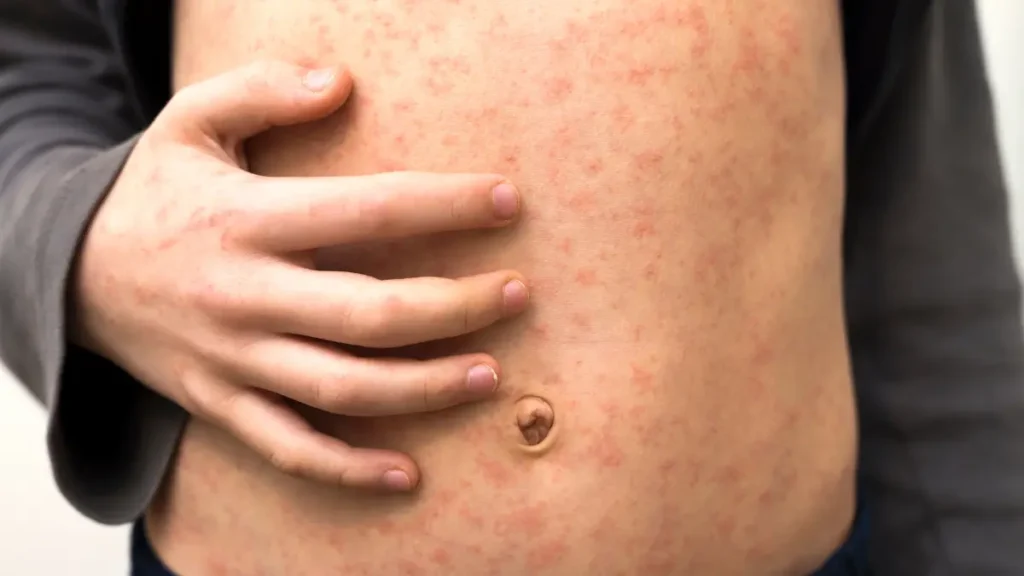 measles rash in adults