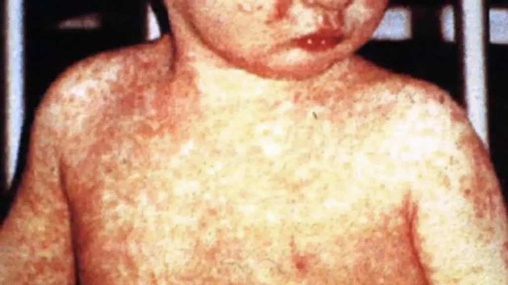 measles rash in child