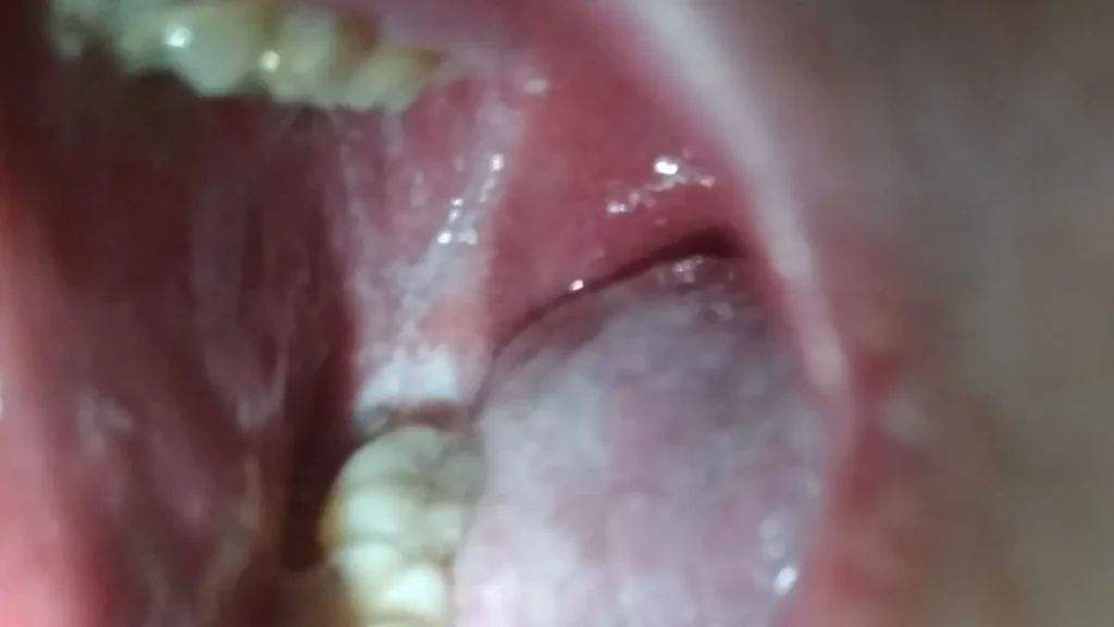 koplik spots inside the mouth