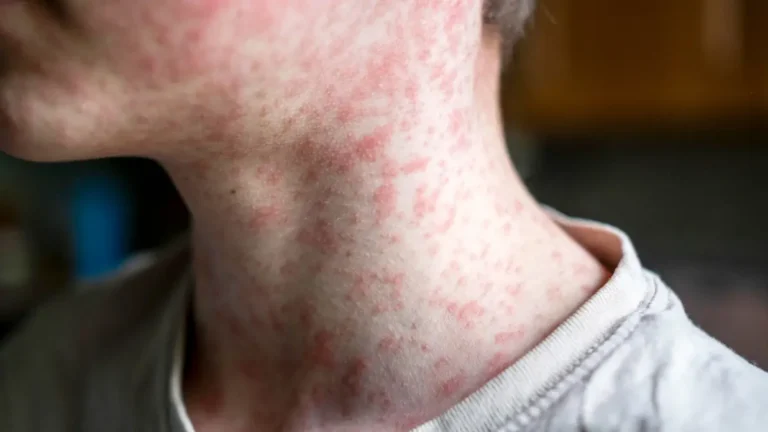 Measles Rash